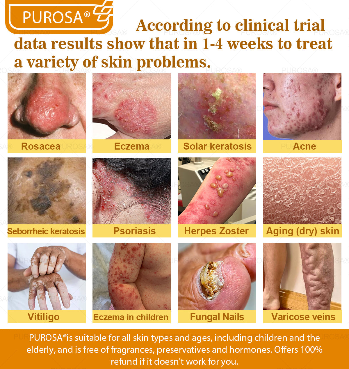 PUROSAĀ® Bee Venom Skin Treatment Cream, Anti-aging, Hydrating, Skin Repair, Even Tone, Acne and Dark Spot Treatment, Wart and Mole Removal, Psoriasis Relief