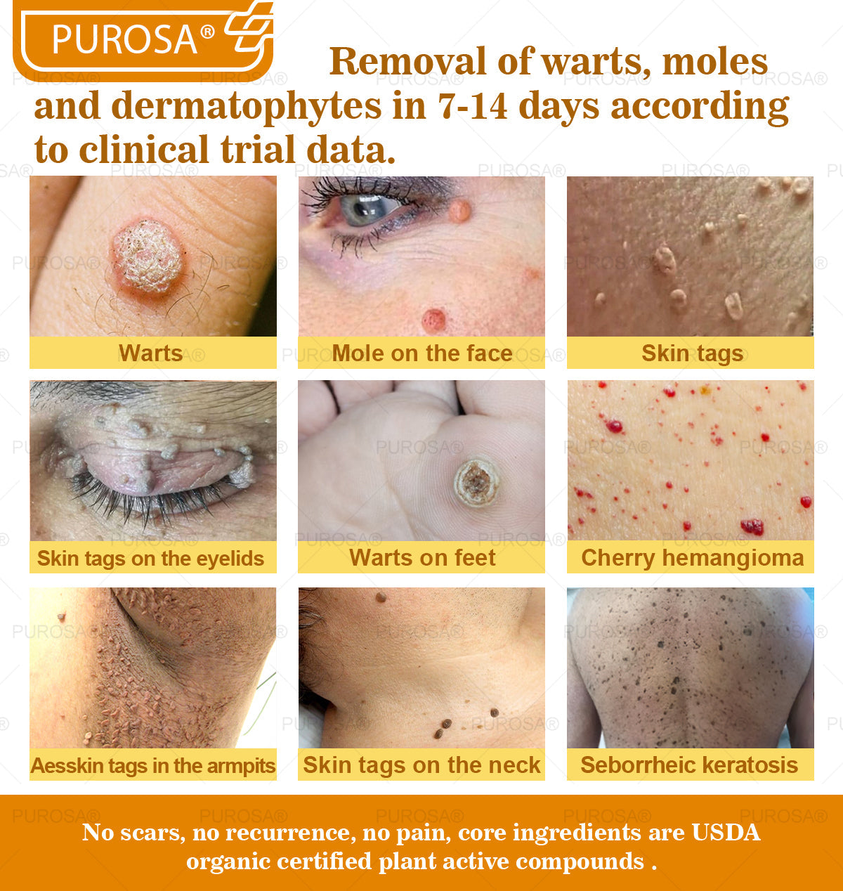 PUROSA® Bee Venom Skin Treatment Cream, Anti-aging, Hydrating, Skin Repair, Even Tone, Acne and Dark Spot Treatment, Wart and Mole Removal, Psoriasis Relief
