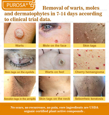 PUROSA® Bee Venom Skin Treatment Cream, Anti-aging, Hydrating, Skin Repair, Even Tone, Acne and Dark Spot Treatment, Wart and Mole Removal, Psoriasis Relief